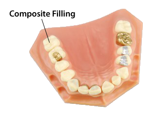 white fillings